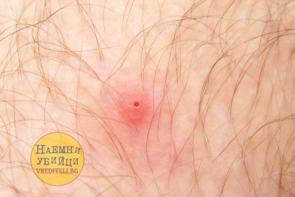 Ухапване от кърлеж - след отсраняване или падане на кърлежа